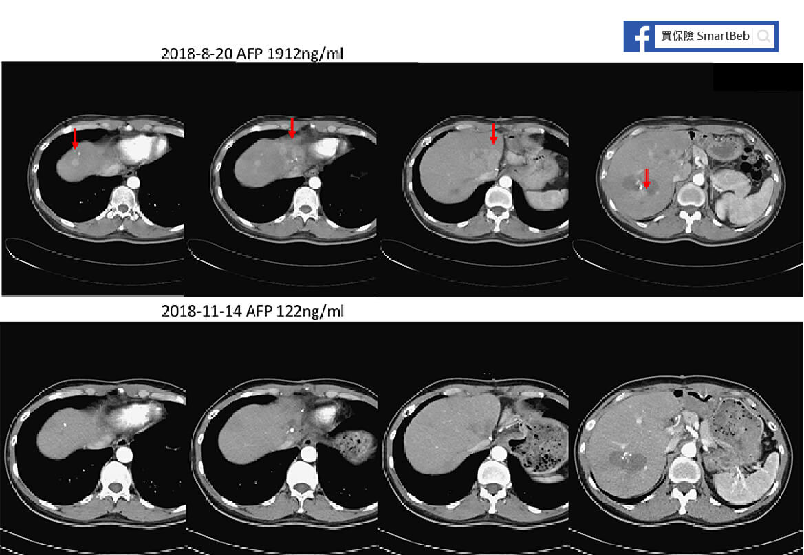 肝癌腫瘤影像圖