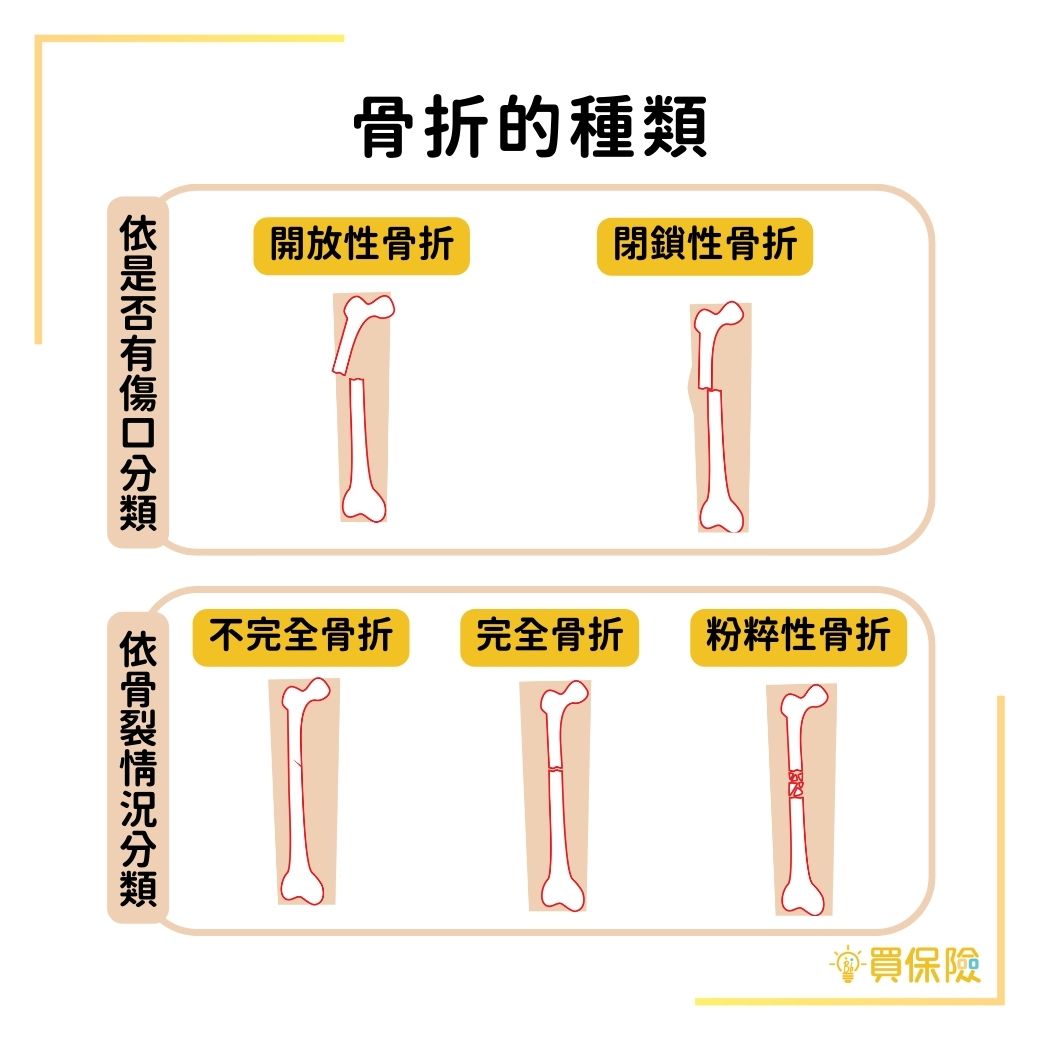 骨折的種類：開放性骨折、閉鎖性骨折、不完全骨折、完全骨折、粉碎性骨折